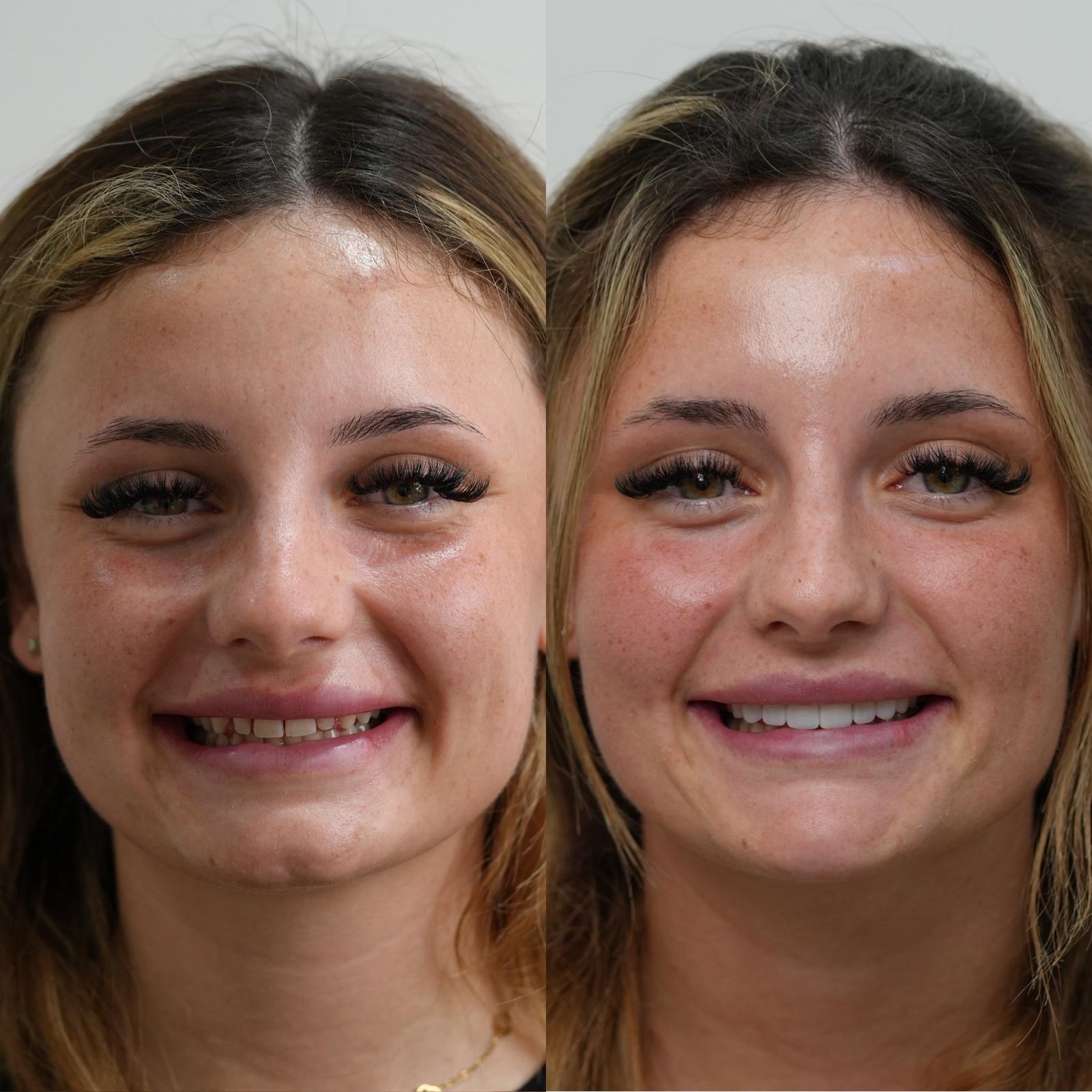 Before and after composite bonding at Teeth by Teki