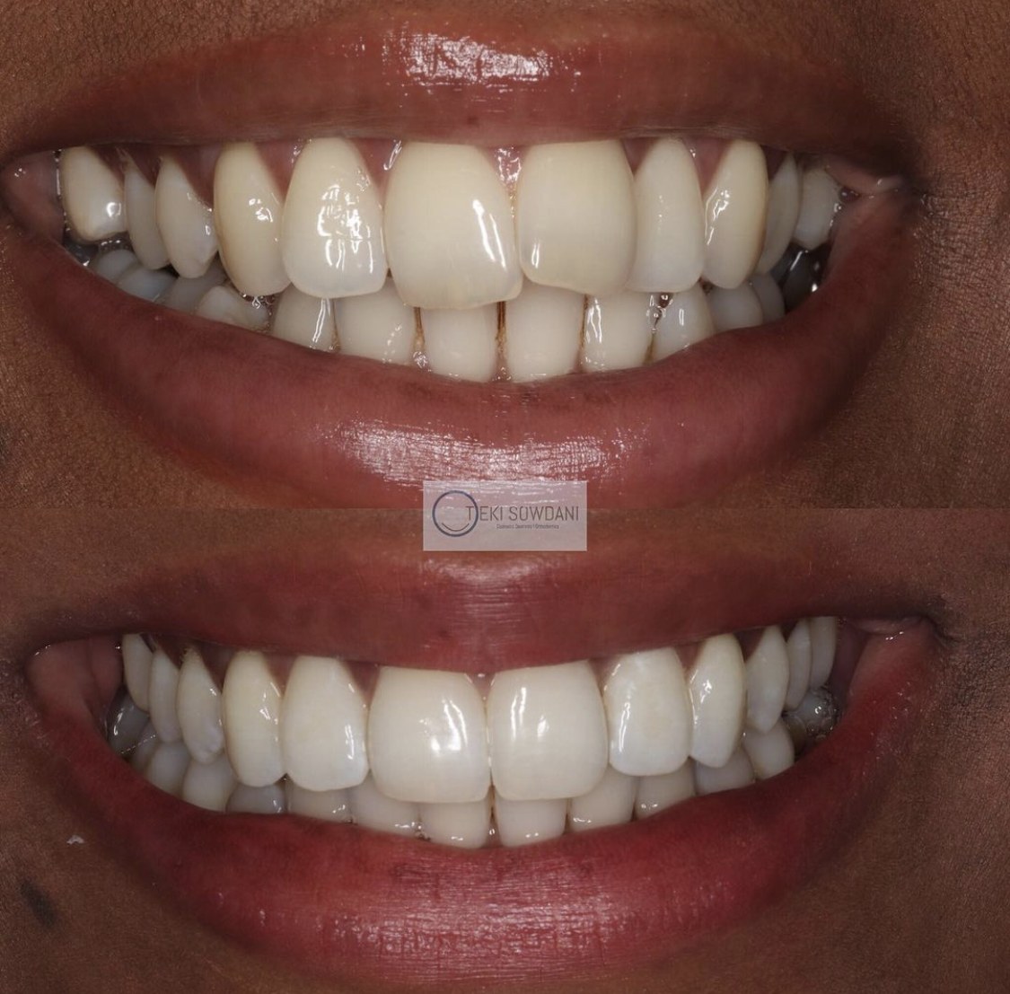 Close-up of a finished composite bonding smile